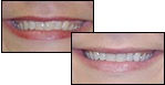 Teeth whitening ain Bismarck, ND at Smiles by Design