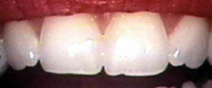 before Enamel Shaping