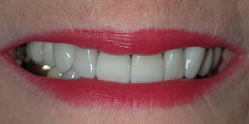 after veneers in Bismarck, ND