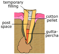 temporary filling